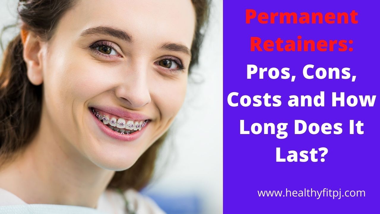 Permanent Retainers: Pros, Cons, Costs and How Long Does It Last?