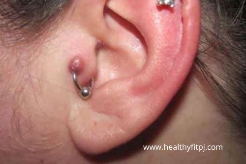 What are Piercing Bumps