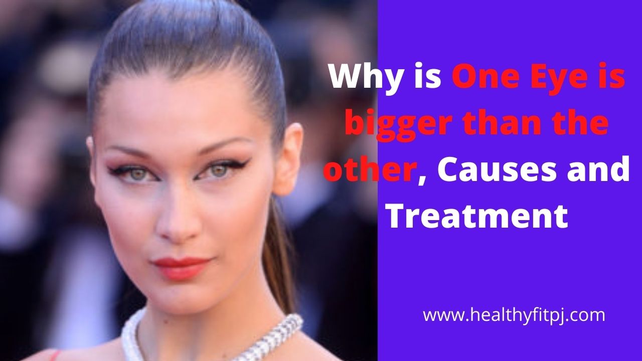 Why is One Eye is bigger than the other, Causes and Treatment